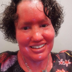 A woman with short dark curly hair, smiling. She has a red face because of Ichthyosis. The photo shows she's wearing a black floral dress and a silver beaded necklace.