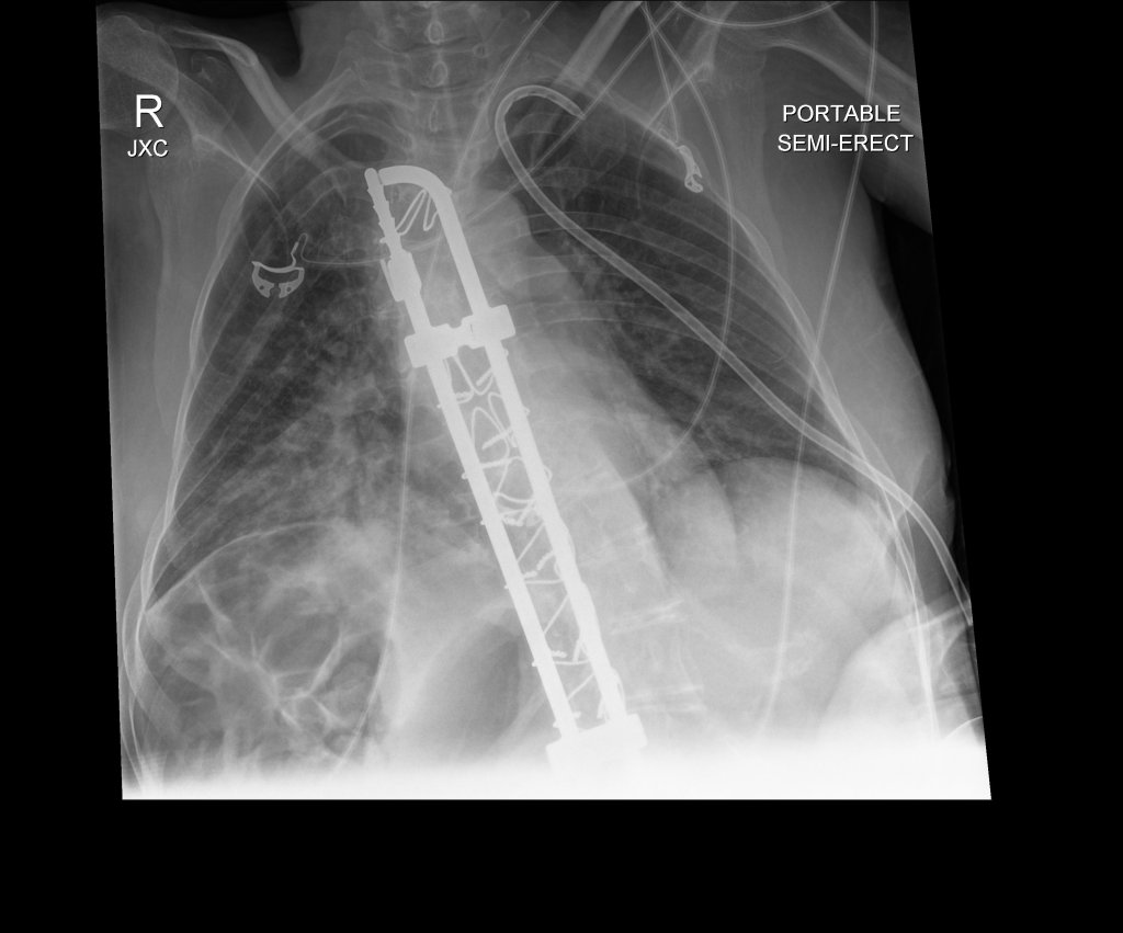 Black and white photo of an x-ray of my chest showing some tubes and a metal rod in my spine. Text says, “PORTABLE SEMI-ERECT” and the letters RJXC”
