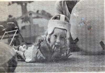 A black and white newspaper clipping of a young little curly-haired blonde, covered by a plastic helmet, lying on the floor on her stomach with her metal walker in the background. She holds her chin up with one of her hands and looks forward. There are physical therapy balls surrounding her.