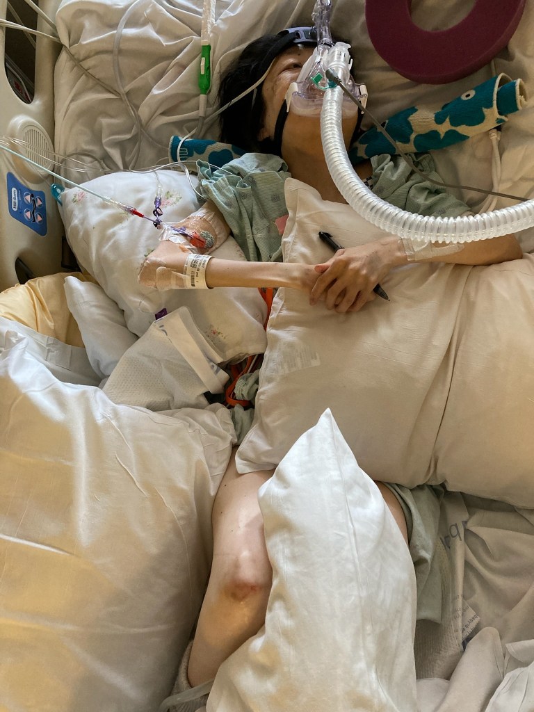 This is me in a hospital bed with a mask over my nose connected to a tube. A wrinkled bed sheet is underneath me with a towel rolled under my neck, a round sponge cushion above me, and numerous pillows under and over my arms and under my hips and between my legs. Bandages and numerous tubes are connected to my right arm.