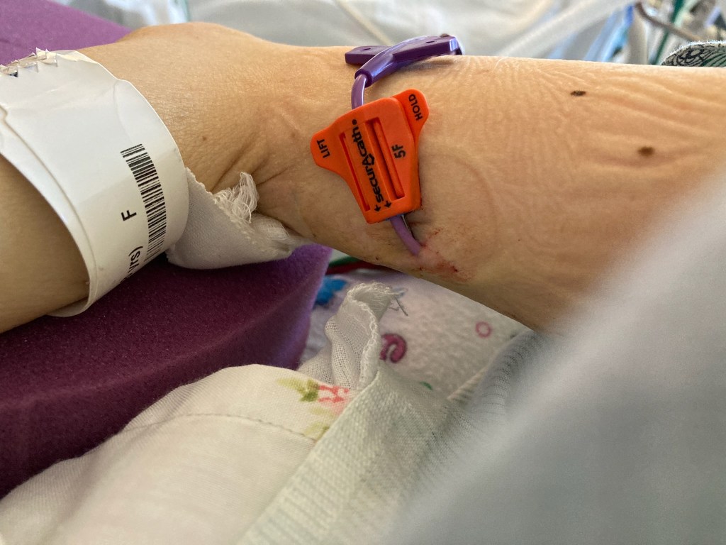 My poor battered and bruised body! I won’t even mention what happened to my poor pussy. My right bony arm rests on a purple foam pillow to prevent skin breakdown with an ID tag around my wrist. In the upper part of the arm is the PICC line, a purple tube inserted into my vein with an orange plastic piece near the entry site.