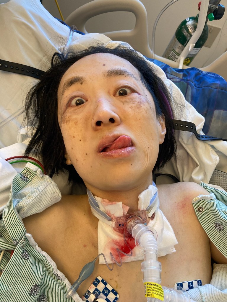 I managed for most of my stay to remain my usual silly, snarky, and charming self even during seriously painful shit. I have no idea when my wounds are going to heal but damn, there’s a LOT to get used to. I am looking weird with my tongue sticking out. My hospital gown is open because of the fresh wound from my tracheostomy. A band is around my neck securing the trach to a tube. A white drain sponge around the wound is soaked with blood.