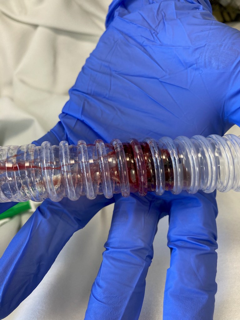 A gloved hand holding a clear tube with a large blood clot inside. I call it my baby since I expelled it from my body with a lot of labor. Holy fucking shit. Once it came out I felt a lot better and now rely on the Cough Assist whenever secretions are too thick and deep.